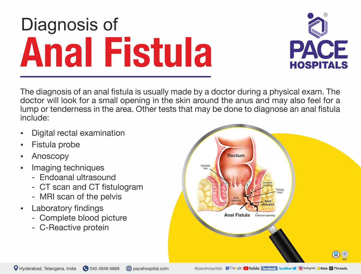 PACEHospitals's tweet image. An #analfistula is an abnormal tunnel-like tract that forms between the #analcanal or #rectum and the skin around the #anus.

Know more: bit.ly/45zyu22

#fistulaproblem #painmanagement #health #gastroenterology #gastroenterologist #pacehospitals #hyderabad #india