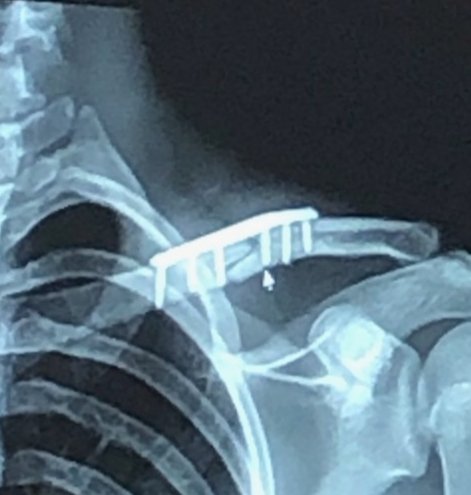 First look at the repaired collarbone!