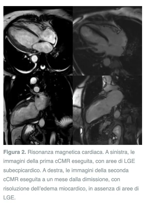 💡🫀ICOT Clinical case of the week🫀🧠 💡

🫀Cardiomiopatia infiammatoria cronica: dalla presentazione clinica all’interpretazione della risonanza magnetica e della biopsia cardiaca 🫀

👉🔎👉🔎👉🔎👉buff.ly/3PHP7mK