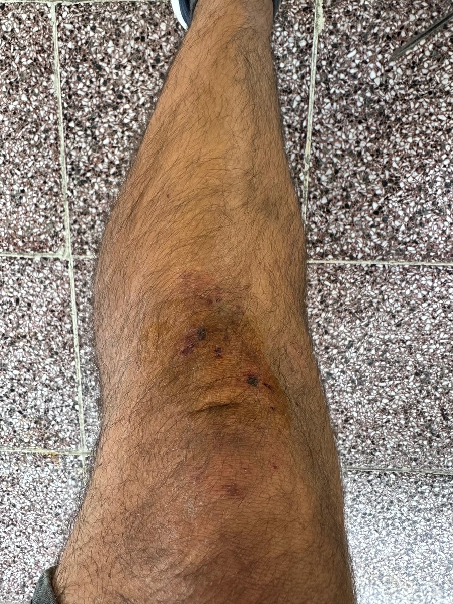 * Astım hastası olduğumu söylememe rağmen kafama ve boynuma basıldı!
* Fotoğraf makinem alınıp yere atıldı!
* 3 saat boyunca ters kelepçe uygulandı!

#Agrobay direnişini takip ederken darp edilerek gözaltına alınan Berkcan Zengin'in ifadesinden... 

#GazetecilikSuçDeğildir