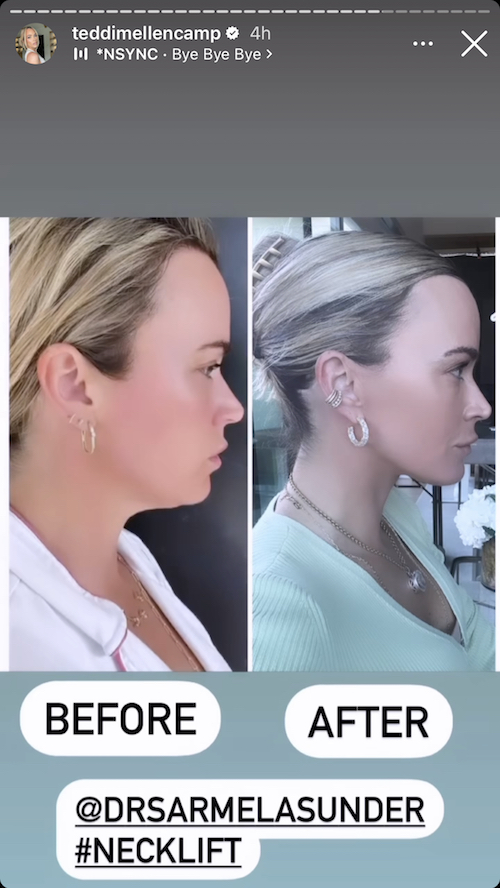 BrightlyAgain's tweet photo. RHOBH Teddi Mellencamp Slams Sutton for Shading Erika's Vegas Residency, Suspects She'll "Cry Victim" When Confronted as Tamra Weighs In, Plus See Before and After Pics of Teddi's Neck Lift #RHOBH #TeddiMellencamp #SuttonStracke https://t.co/4wyFG8DFqk via #realityblurb https://t.co/ATq4aVWFYp
