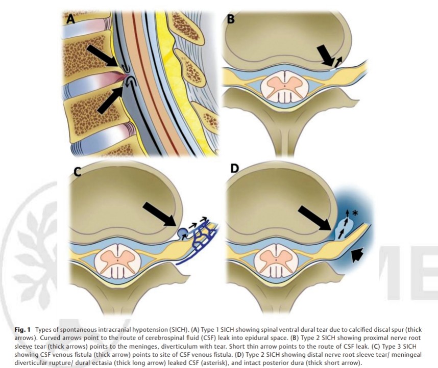 SharathKumarGG7's tweet image. Happy to Share our publication, the first of a kind review article from India on SIH! #sih #SpinalCSFleak #Csf #headache @SavithKumarINR @csfleakuk @CsfLeakIreland @csfleakaware @SpinalCSFCanada #radiology #neurorad #neurology #neuroscience #NeuroTwitter @ApolloKarnataka