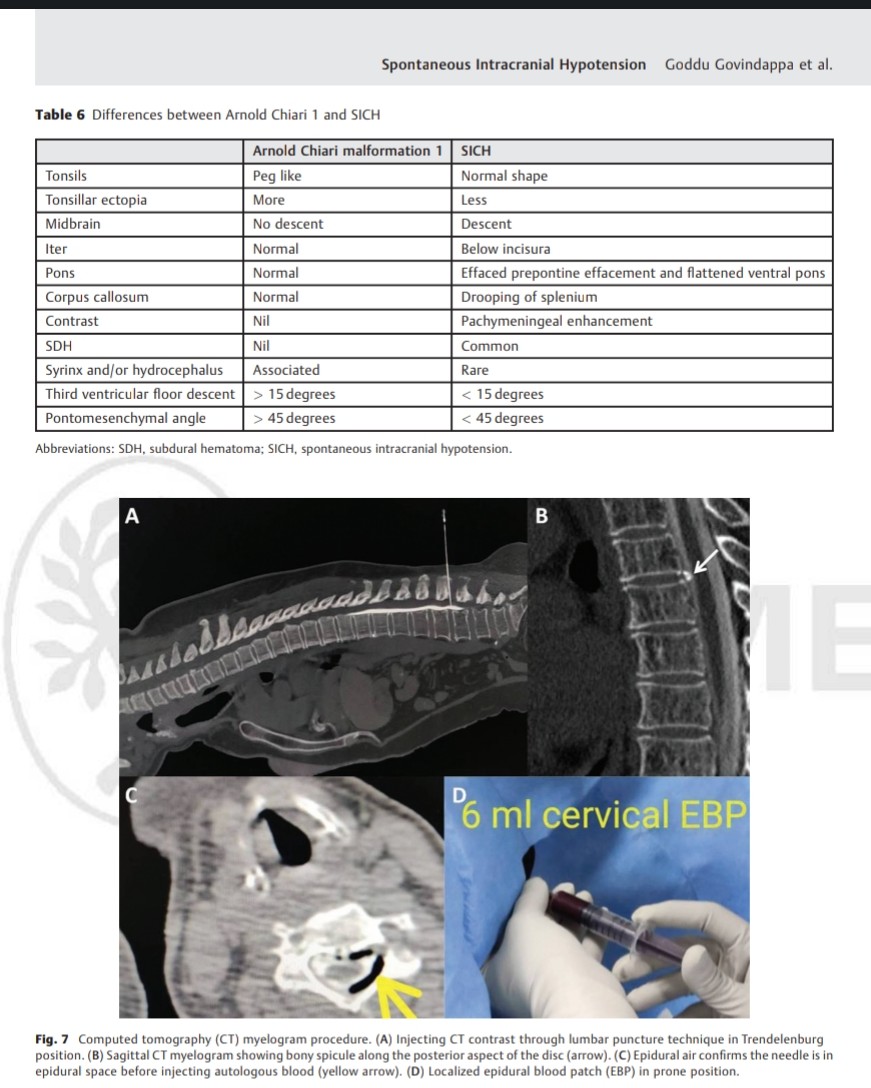 SharathKumarGG7's tweet image. Happy to Share our publication, the first of a kind review article from India on SIH! #sih #SpinalCSFleak #Csf #headache @SavithKumarINR @csfleakuk @CsfLeakIreland @csfleakaware @SpinalCSFCanada #radiology #neurorad #neurology #neuroscience #NeuroTwitter @ApolloKarnataka