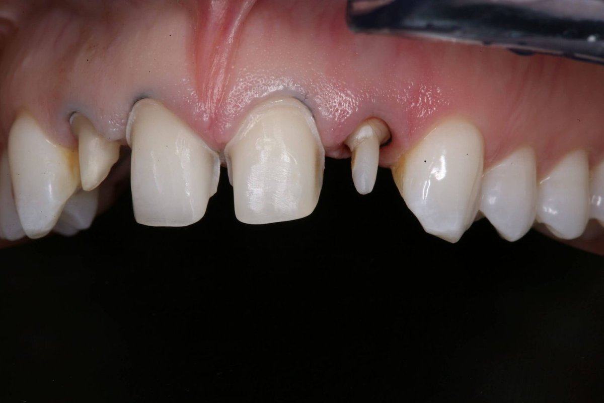 How Ferrule Impacts Restorative Decisions by Lee Ann Brady DMD <a href="/LeeAnnBrady/">Lee Ann Brady</a> #dentistry bit.ly/3oj7eB9