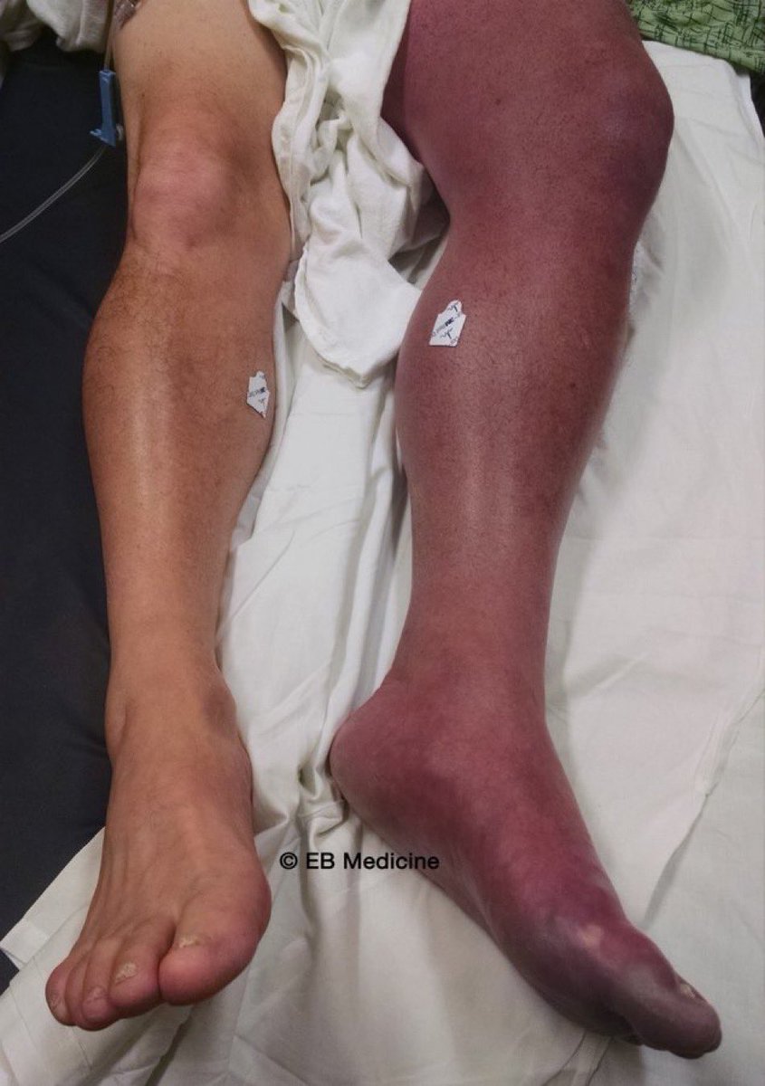 Journal of Brown Hospital Medicine (@brownjhm) on Twitter photo 44,โ๏ธ, left lower limb pain & swelling x 4days.
Examination๐๐ป
Diagnosis?
H/t <a href="/nihardesai7/">๐ก๐ถ๐ต๐ฎ๐ฟ ๐๐ฒ๐๐ฎ๐ถ MD, DM</a> 44,โ๏ธ, left lower limb pain & swelling x 4days.
Examination๐๐ป
Diagnosis?
H/t <a href="/nihardesai7/">๐ก๐ถ๐ต๐ฎ๐ฟ ๐๐ฒ๐๐ฎ๐ถ MD, DM</a>