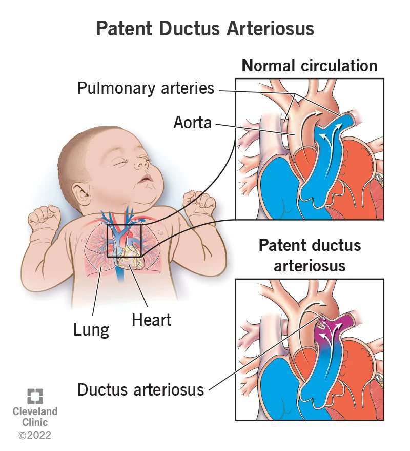 @BrownJHM @ParrasJorge2 Patent ductus arteriosus (PDA)
