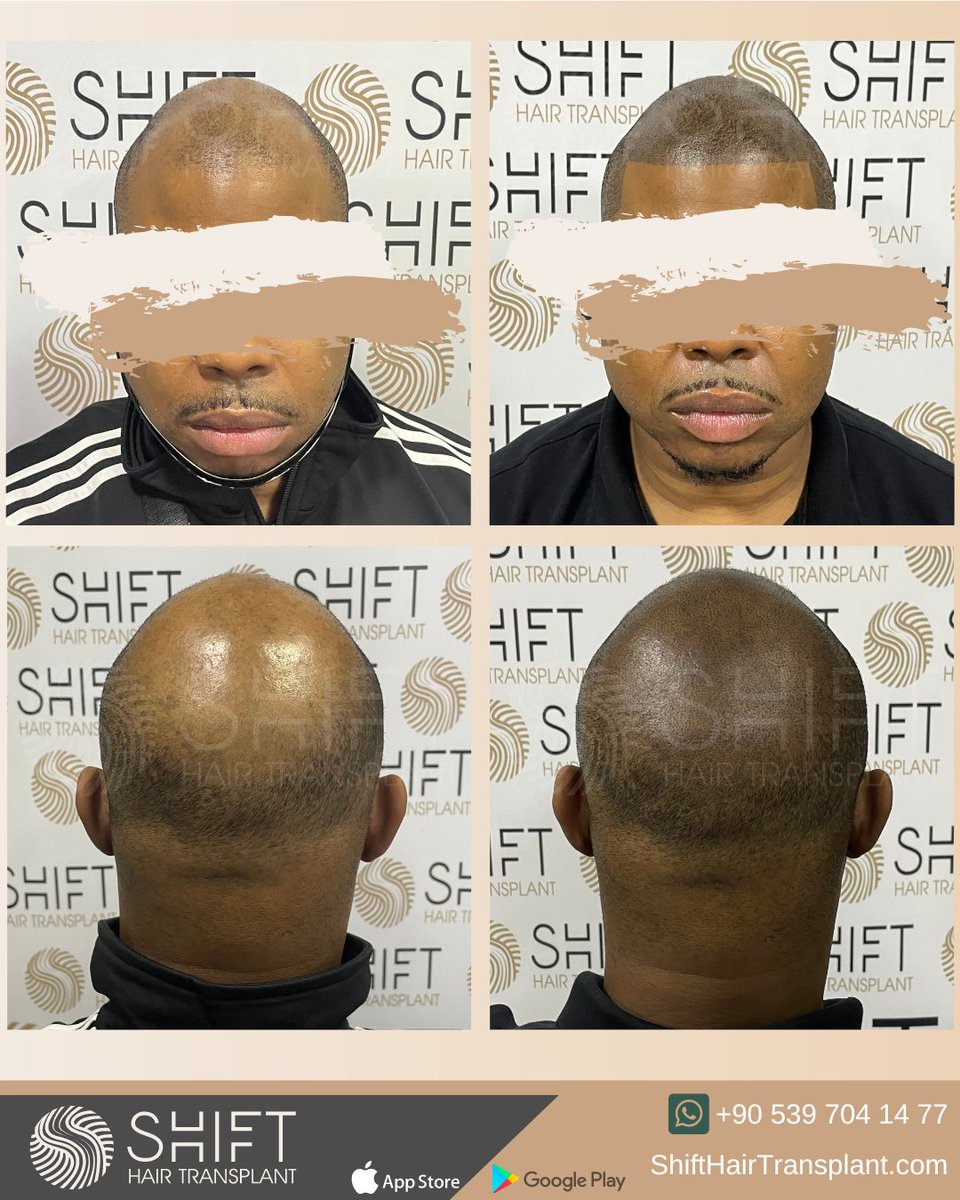 shifthairtr's tweet image. Micropigmentation Magic for African Americans in Istanbul, Turkey

#scalpmicropigmentation #micropigmentation #smp #hairtattoo #hairshading #micropigmentationturkey #micropigmentationistanbul #micropigmentationinturkey #micropigmentationinistanbul #micropigmentationartist