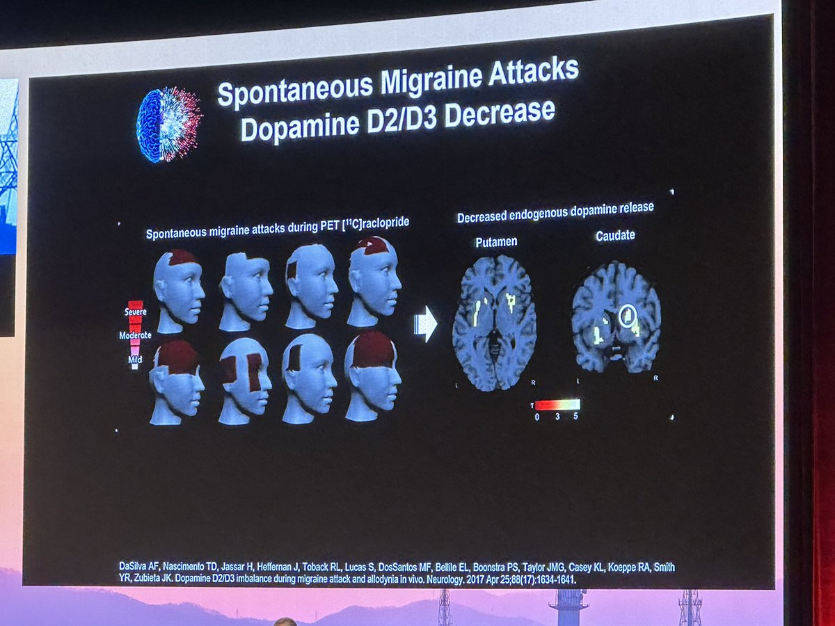 DrElenaGross's tweet photo. During a migraine attack there is a decrease in dopamine. The brain is reducing thereby any behavior. This information every well with my „energy- conservation“ theory. Great talk by Dr Alexandre Da Silva @ihs_official #IHC2023. https://t.co/mTtDKe2vwn
