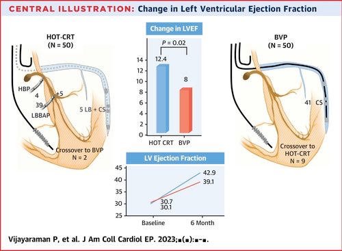 HOT-CRT Trial 

📌In a study of 100 patients, #HOT-#CRT showed a 96% success rate vs. 82% for BVP-CRT (P=0.03). 

📌Both pacing techniques reduced QRS duration, with similar procedure times. 

 📌 LVEF ⤴️ at 6 months was greater with HOT-CRT (12.4%) vs #BVP (8.0%, P=0.02).