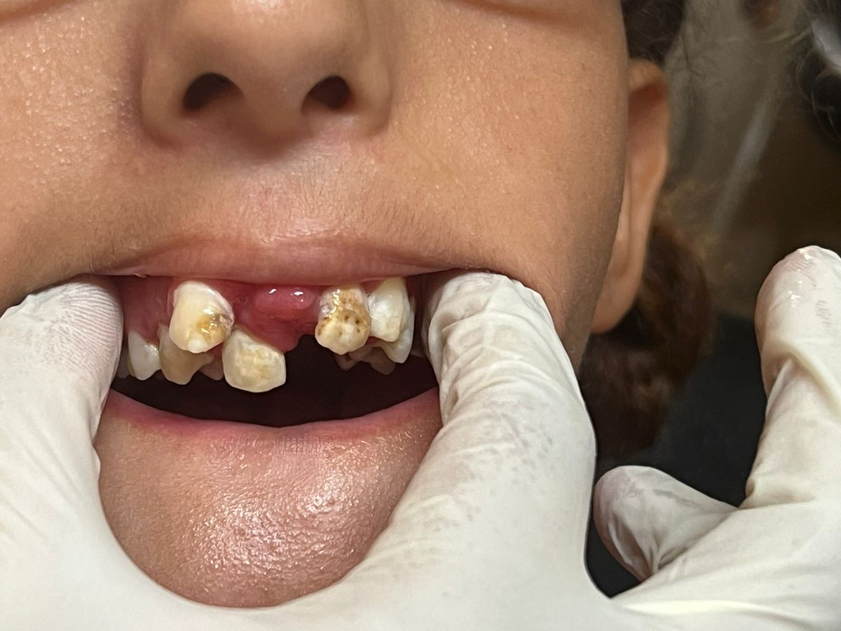 JustinePienaar's tweet photo. ๐Together we can make a change and give this girl the smile she deserves๐you can help by please sharing this! https://t.co/WSX9RzOTD3 #GoFundMe #helpinghands #smileagain #Donations #support #Funding #medicalsupport #surgerysupport https://t.co/MqxEVp9h2Q