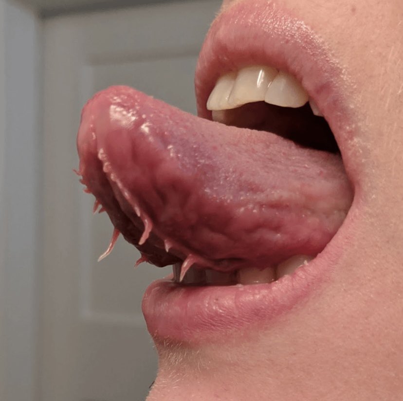 Some people have a condition where the fringed fimbriated folds (also known as plica fimbriata) under their tongue are quite prominent. These folds are naturally a part of the mucous membrane that runs below the tongue.