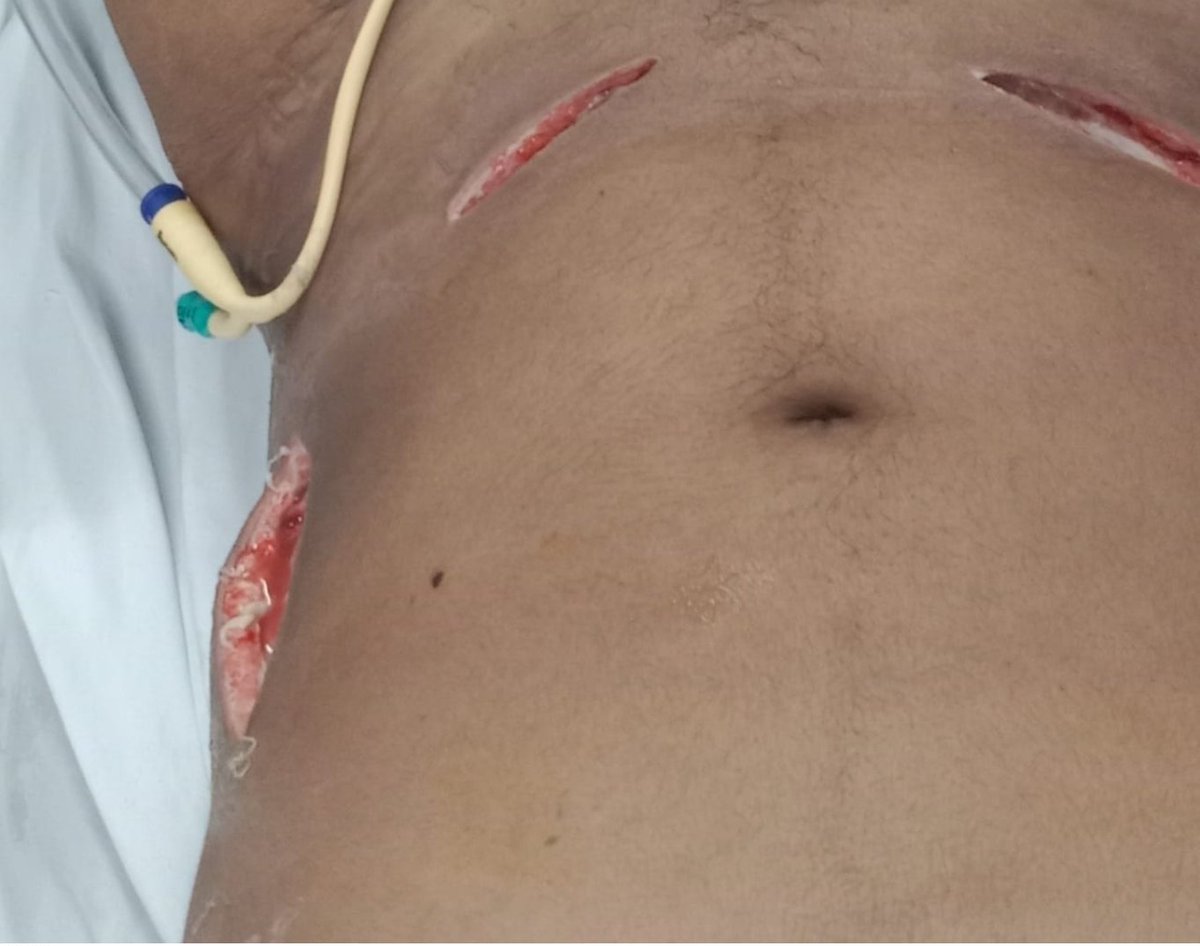 We do not post all the work we do and seldom do we do individual fundraising. We respond to cases after verification and depend on your donations. Here is a a patient suffering from Cellulitis scrotal abscess C sepsis shock. May Allah reward our donors.   charityalliance.in/india/