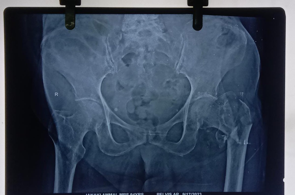 94 year old female , K/c/o CAD,COPD on medications 
Fix (PFNA2 with augmentation plate) or replace 
#orthotwitter