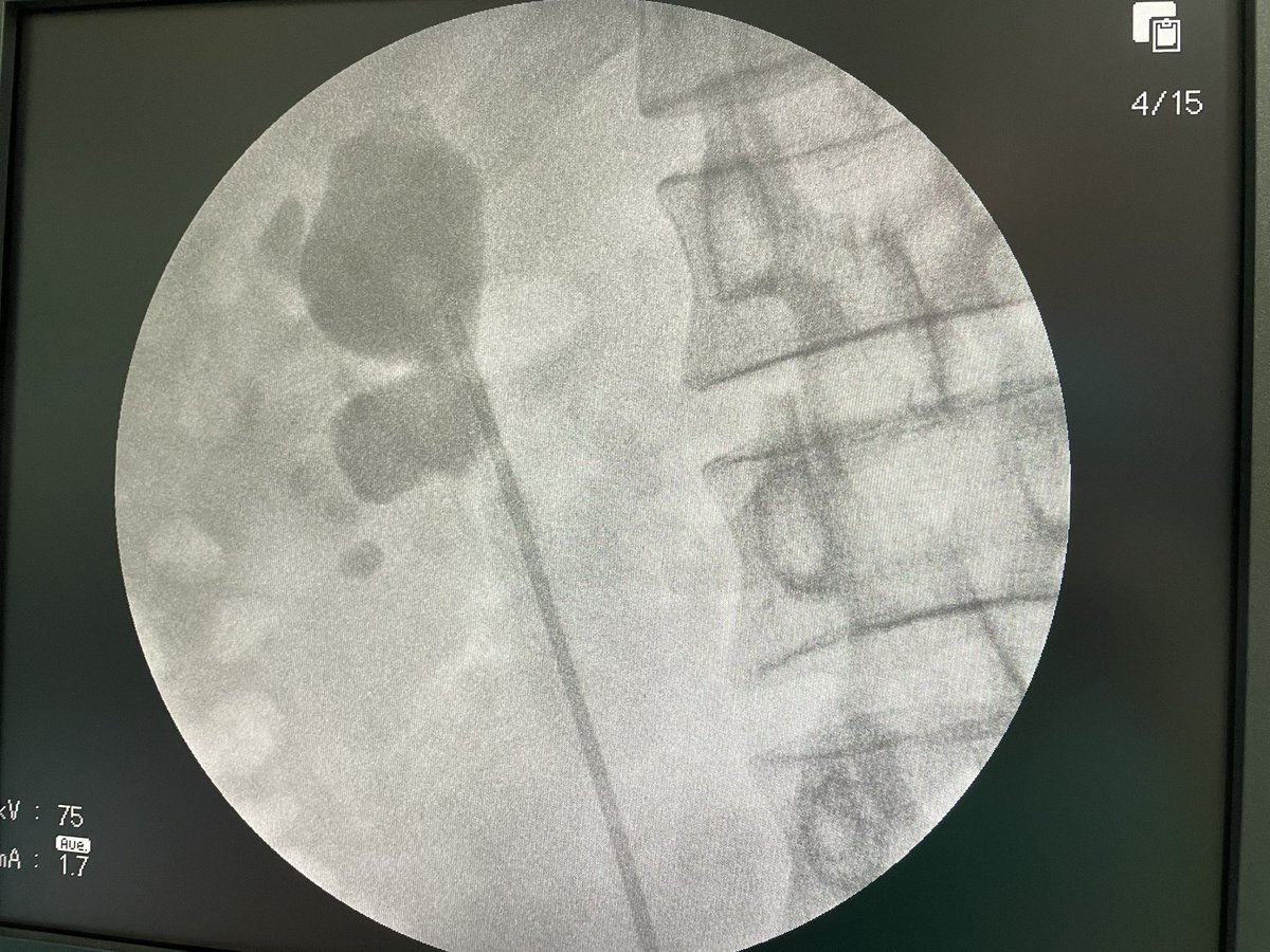 ThengHang's tweet photo. Mini-PCNL (MIP M), my second case. https://t.co/76DRdTuIg3