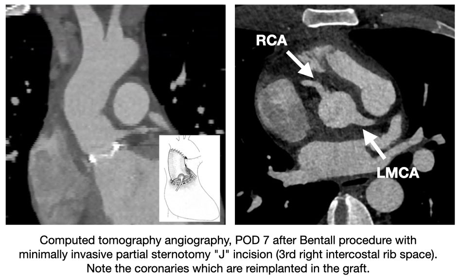 ✅ Bentall procedure through an upper J-shaped ministernotomy
The standard access to the ascending aorta is a full midline sternotomy. An alternative access to the ascending aorta and aortic valve is an upper J-shaped sternotomy. #bav #aorta #aneurysm #minimallyinvasive #bentall