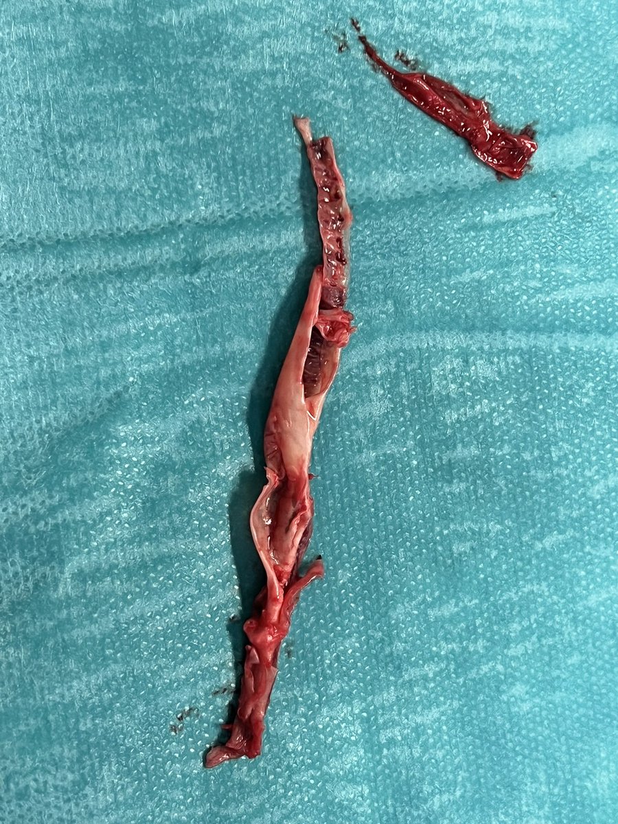 When doing a thrombectomy of an arteriovenous graft (#AVG) make sure to pass through several times (and ideally under ultrasound guidance), because look at this old white crap coming out of it (72 hours old occlusion). #VascularAccessCenter #Hamburg #AKB #Asklepios #Barmbek