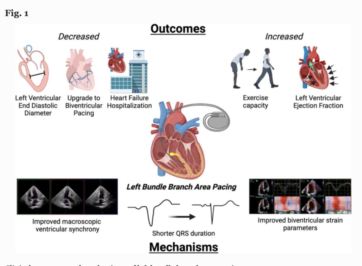 Fantastic editorial by <a href="/JICE_EP/">JICE</a> editorial training fellow <a href="/GrahamPeigh/">Graham Peigh, MD, MSc</a> and <a href="/ba_steinberg/">Benjamin Steinberg</a>  for recent article

Mechanisms for Structural Remodeling with Left Bundle Branch Area Pacing: More than Meets the Eye
rdcu.be/dml7i

#EPeeps