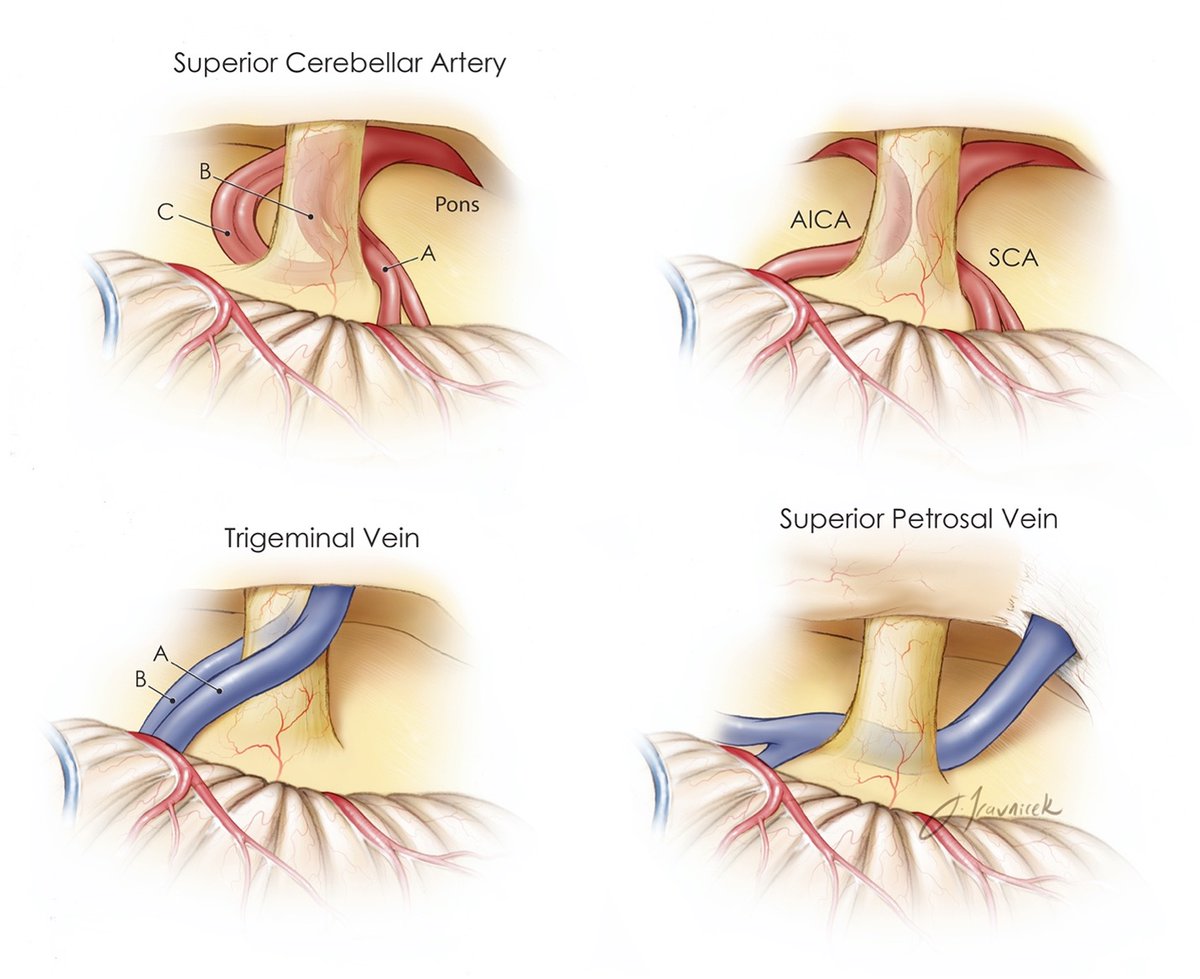 neurosurgatlas's tweet photo. In trigeminal neuralgia (TN), CN V is compressed by a vascular structure, causing severe pain. Which vessel is the most common culprit in TN? What is the principle behind the surgical management of TN?

 #MedTwitter #Neurosurgery #NSGY #surgery https://t.co/0Wvmm64YTU