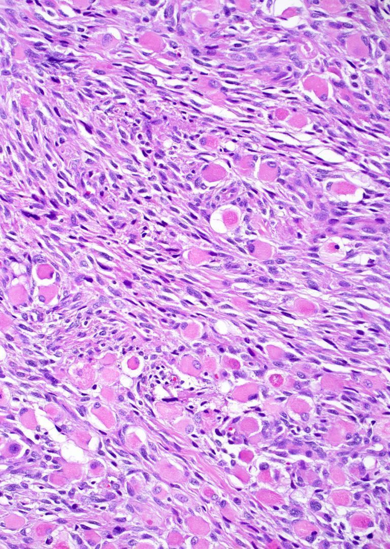 35 F with NF1. Can you make the diagnosis from one pic, or is it #TooCloseToDiagnose? More pics: kikoxp.com/posts/16855 Answer: kikoxp.com/posts/15995 101 video: kikoxp.com/posts/4092 #BSTpath #pathologists #pathology #pathTwitter