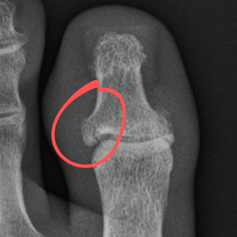 The week I fractured my toe hiking in the alps

I was over 2,000 vertical ft from the trailhead when it started raining

Rain and rocks don't mix well...

petermeglis.com/blog/life-upda…