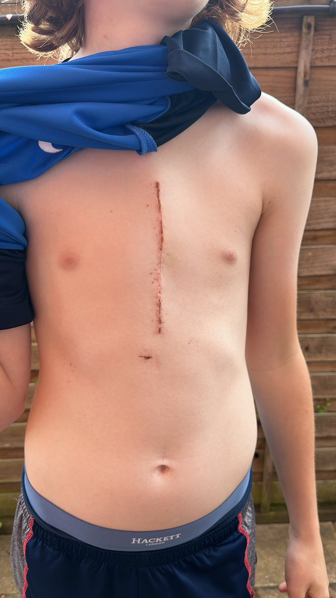 ButterfillJames's tweet photo. @Fraserfranks Stay strong, my son has just had a very similar operation. He’s back playing sport and smashing life - the scar simply makes you special - keep the faith ❤️ (strong heart) you are a warrior https://t.co/DJ5kX0mVTw