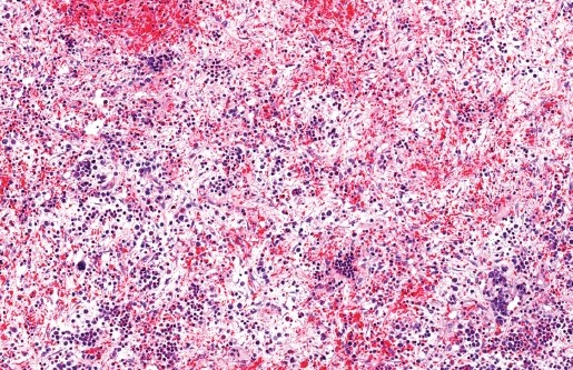 OncologyTimes's tweet image. Research revealed promising treatment in patients with primary or secondary #myelofibrosis who have shown a suboptimal response to ruxolitinib. Navtemadlin was added to the existing regimen to evaluate safety, efficacy, and tolerability. #EHA2023 ow.ly/J9qK50OQGpr