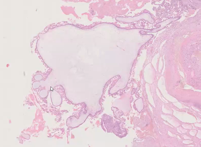Janiranavarro's tweet photo. Complete mole
1. Circumferential trophoblastic hyperplasia
2. Karyorrhectic debris (look at most preserved villi)
 Dr. Kaur #ISGyP #perinatalpath #PathX #PathTwitter #Pathology #gynpath #everydayGYN https://t.co/IQ5lwxTTIX