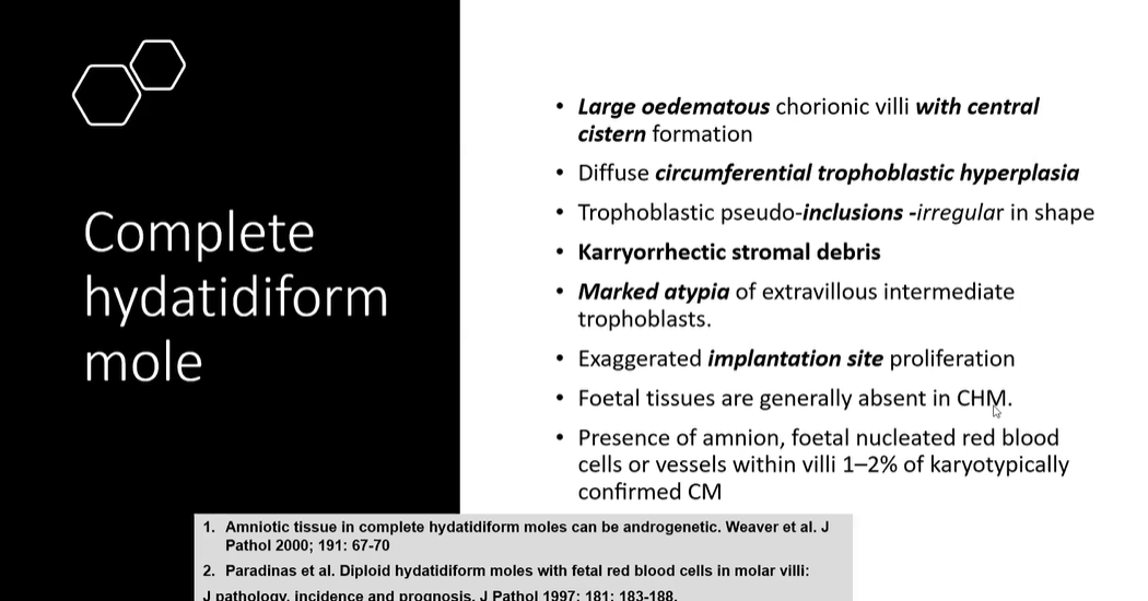 Janiranavarro's tweet photo. Complete mole
1. Circumferential trophoblastic hyperplasia
2. Karyorrhectic debris (look at most preserved villi)
 Dr. Kaur #ISGyP #perinatalpath #PathX #PathTwitter #Pathology #gynpath #everydayGYN https://t.co/IQ5lwxTTIX