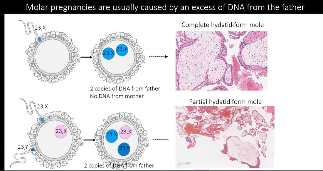 Janiranavarro's tweet photo. Molar pregnancies are usually caused by an excess of DNA from the father
Dr. Kaur #ISGyP #perinatalpath #PathX #PathTwitter #Pathology #gynpath #everydayGYN #newinpractice https://t.co/4zP7g5swqy