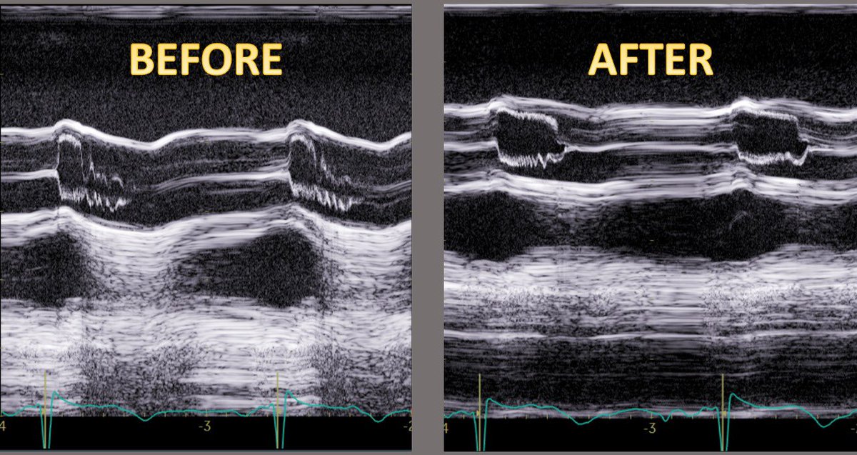 Edgar Fuentes Molina (@dredgarfuentes) on Twitter photo 📍 What procedure was performed and what was the result ⁉️
#echofirst
<a href="/jusrtrysa12/">Juliana Salas</a> <a href="/SISIACOficial/">SISIAC</a> <a href="/MAecocardio/">MA Garcia Fernandez</a> <a href="/VazyurVasquez/">Zuilma Vásquez</a> <a href="/Sochicaroficial/">Soc. Chilena de Cardiología</a> <a href="/SONECOM_AC/">SONECOM</a> <a href="/ESC_Journals/">European Society of Cardiology Journals</a> <a href="/ASE360/">American Society of Echocardiography</a> <a href="/jorgeachv/">Jorge A. Chavarria V. 🇨🇦 🇪🇸 🇨🇷.</a> <a href="/HugoMartinezCMR/">Hugo Martínez</a> <a href="/SONECOM_AC/">SONECOM</a> <a href="/josejgdnews/">Jose Juan Gomez</a> <a href="/iamritu/">Ritu Thamman MD</a> <a href="/mariovar55/">Mario Vargas Galgani</a> <a href="/Ivan_Echocardio/">Ivan Stankovic</a> <a href="/almasthela/">Alma Sthela Arrioja, MD</a> 📍 What procedure was performed and what was the result ⁉️
#echofirst
<a href="/jusrtrysa12/">Juliana Salas</a> <a href="/SISIACOficial/">SISIAC</a> <a href="/MAecocardio/">MA Garcia Fernandez</a> <a href="/VazyurVasquez/">Zuilma Vásquez</a> <a href="/Sochicaroficial/">Soc. Chilena de Cardiología</a> <a href="/SONECOM_AC/">SONECOM</a> <a href="/ESC_Journals/">European Society of Cardiology Journals</a> <a href="/ASE360/">American Society of Echocardiography</a> <a href="/jorgeachv/">Jorge A. Chavarria V. 🇨🇦 🇪🇸 🇨🇷.</a> <a href="/HugoMartinezCMR/">Hugo Martínez</a> <a href="/SONECOM_AC/">SONECOM</a> <a href="/josejgdnews/">Jose Juan Gomez</a> <a href="/iamritu/">Ritu Thamman MD</a> <a href="/mariovar55/">Mario Vargas Galgani</a> <a href="/Ivan_Echocardio/">Ivan Stankovic</a> <a href="/almasthela/">Alma Sthela Arrioja, MD</a>