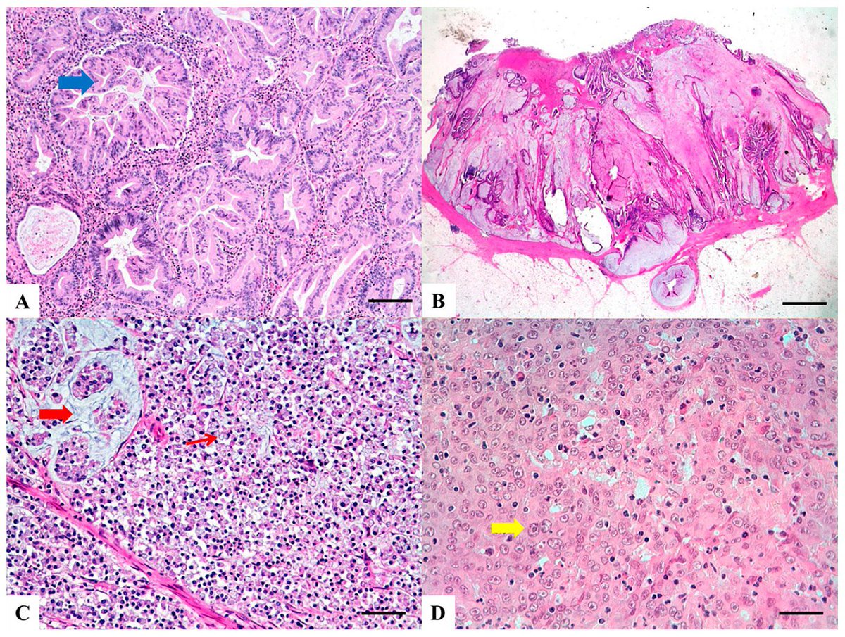 preposterjohn's tweet photo. Think I can’t waffle on about colorectal cancer? https://t.co/rSQg2D3WDM @OncoPharmPod @JCOGO_ASCO @oncologynursing @TargetedOnc @InquisitiveOnc @JAMAOnc @OncNursingNews @ColonCancerCoal @ColonCancerFdn @oncologyCOA @TheOncNurse @OncologyCentral _ @theNCI @AmericanCancerS https://t.co/RKu3mbePiH