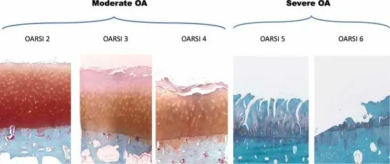Microstructural and cellular characterisation of the subchondral trabecular bone in human knee and hip #osteoarthritis using synchrotron tomography <a href="/DrDzenitaM/">Dzenita Muratovic</a> <a href="/QuarringtonRyan/">Dr Ryan Quarrington</a>
Read more in the September issue of OAC
buff.ly/44NIuDE