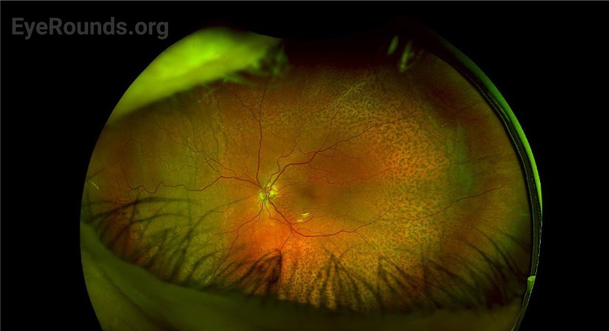 Check out this case on EyeRounds!

A 74-year-old patient has a “leopard-spot” fundus. What could be going on?

Find the answer here:
webeye.ophth.uiowa.edu/eyeforum/cases…

<a href="/NoorusabahAhmad/">Noor-Us-Sabah Ahmad</a> 
@ASGoldsteinMD
