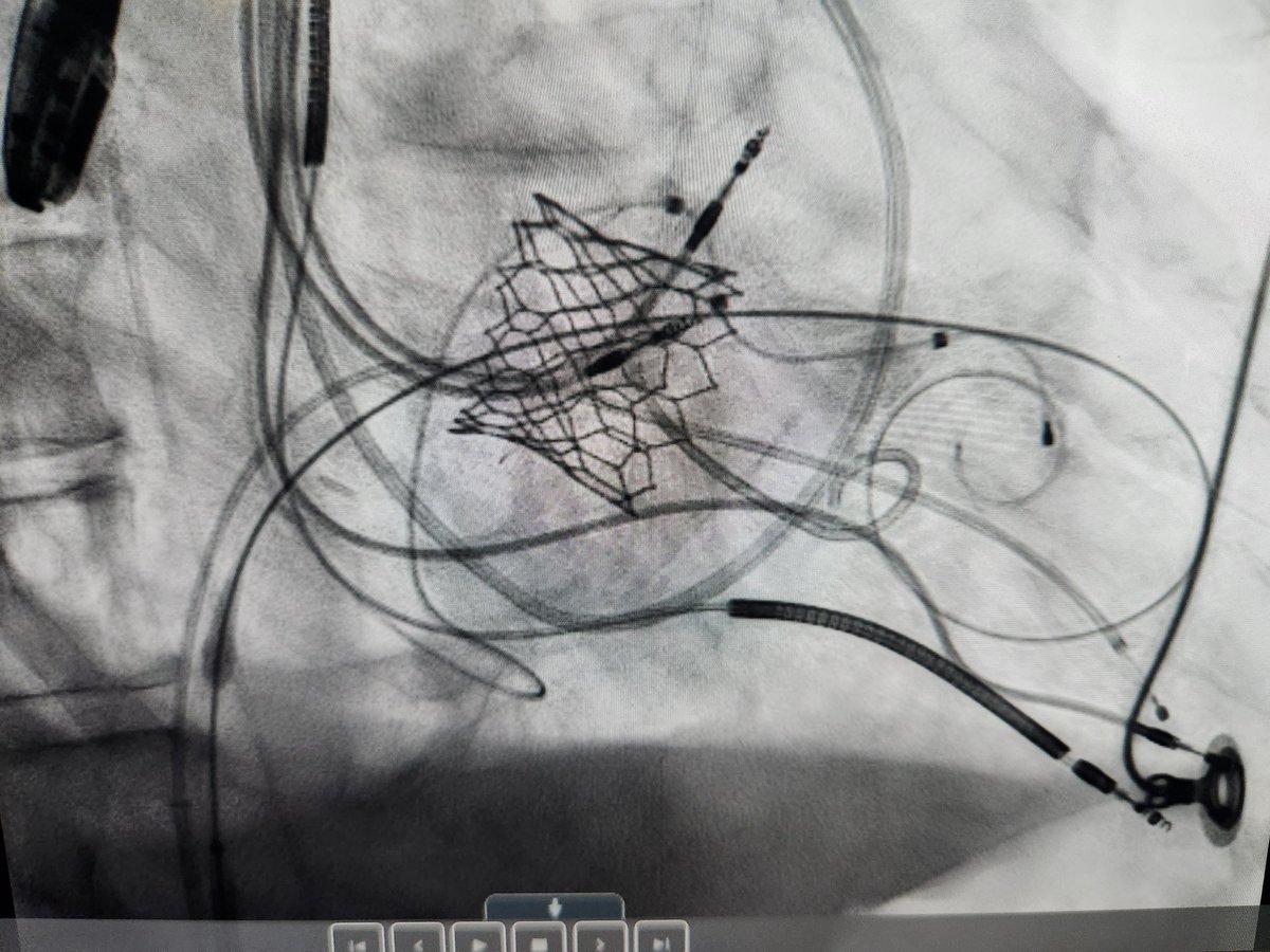 AKassier's tweet photo. Performed successful #vivTMVR with excellent results using 29 ES. From ICU to home within 48 hrs post procedure! Cr already at half. @FollowMercy @MercySGF @Edwards_TAVR @SCAI https://t.co/sGjyqHPa3D