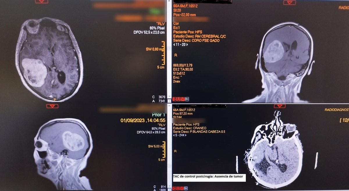 🧠 La Unidad de Neurocirugía extirpa un tumor cerebral con el sistema de neuronavegación y aspirador ultrasónico

ℹ️ La intervención se prolongó durante 10h y fue realizada por los neurocirujanos Abdelmalik El Barkani y Mario Castañeda y el anestesista Mohamed Mohamed Mohtar
