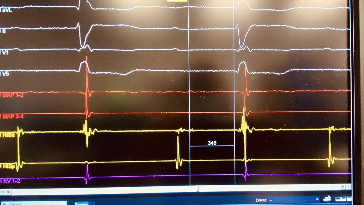 Javier Jimenez Candil (@jjimenezcandil) on Twitter photo The longest basal HV I have ever seen. It is not fragmented atrium. Patient with bundle branch reentry VT…
<a href="/mike__sierra/">Manuel</a> <a href="/JFPortales70/">JPortales</a>, <a href="/odbobin/">Olga Durán Bobin</a>, <a href="/TomasDatino/">@TomasDatino</a>, <a href="/jlmorinigo1/">José Luis moriñigo</a>, <a href="/ACruzGalban/">Alba Cruz</a> The longest basal HV I have ever seen. It is not fragmented atrium. Patient with bundle branch reentry VT…
<a href="/mike__sierra/">Manuel</a> <a href="/JFPortales70/">JPortales</a>, <a href="/odbobin/">Olga Durán Bobin</a>, <a href="/TomasDatino/">@TomasDatino</a>, <a href="/jlmorinigo1/">José Luis moriñigo</a>, <a href="/ACruzGalban/">Alba Cruz</a>