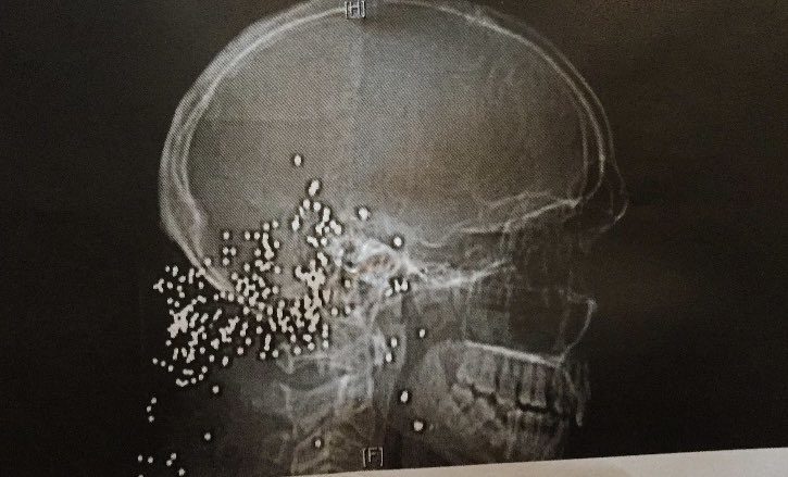 A rather “rural” patient came in with new-onset seizures. CT reveals small metal pellets in head. Patient states his wife accidentally shot him several years ago while trying to get a raccoon off their property.