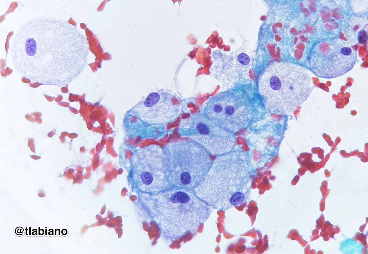 tlabiano's tweet photo. 🩵🫧Foam cells in a cystic breast lesion - Wishing you all a great start on Monday!! 🫶🏼✨
#FNA #beautyandbenign #breastpath #cytopath #routine #mondaymotivation @gildasantoscyto  @IACytology https://t.co/23fYtKNa21