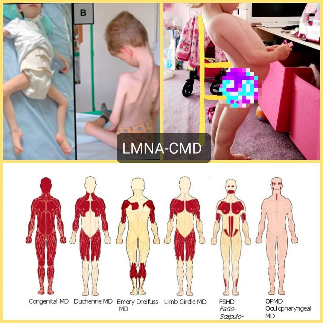 Cure4Carmela's tweet image. It's Muscular Dystrophy Awareness Month.
Here are a few photos to show you what happens to me and others with my very rare type of MD called LMNA-CMD.  It only affects around 1 in a million babies. @MDUK_News
@FoundationLcmd @CureCMD