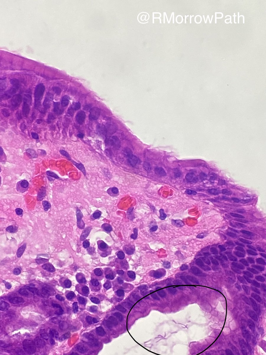RMorrowPath's tweet photo. Gastric biopsy. Name the bug (in the black circle). #pathology #GITpath #crittersontwitter https://t.co/b92hbSNCJh