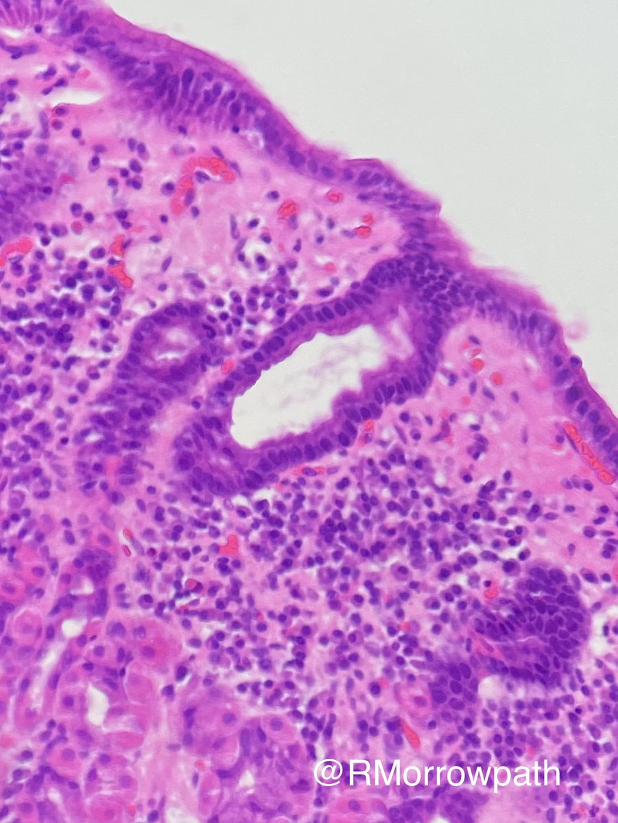RMorrowPath's tweet photo. Gastric biopsy. Name the bug (in the black circle). #pathology #GITpath #crittersontwitter https://t.co/b92hbSNCJh
