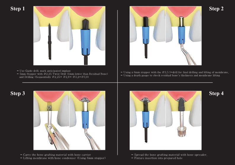 csmimplant's tweet photo. Sinus Lift Kit (Crestal) 
#surgicalkits #manufacturing #koreanmanufacturing #dentalimplants #implantskorea https://t.co/WnRTdaG2tC