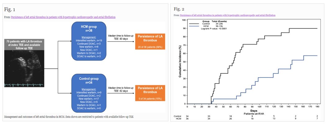 🚨Latest #FreeRead in Article in @JICE_EP Persistence of Left Atrial Thrombus in Patients with Hypertrophic Cardiomyopathy & Atrial Fibrillation by @DanBurczakMD Chris Scott, @akillumd @abhishek_mbbs @ciorsti @noseworthypeter & @konsiont 📖🧐rdcu.be/dmqxD #EPeeps