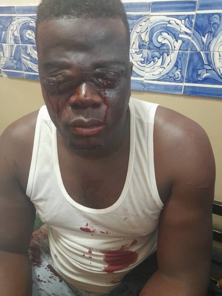 namibiansun's tweet photo. A bus driver from Okahandja is receiving treatment in the Windhoek Central Hospital after he reportedly lost both his eyes during an attack in Johannesburg last week. https://t.co/OhLoIzftUZ https://t.co/S70WC3KIQy