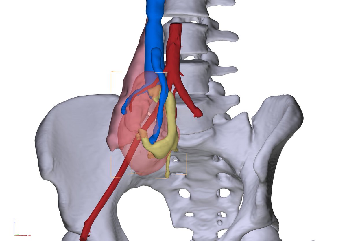 FabLab 3D Hospital Marañón (@3d_maranon) on Twitter photo Anatomical virtual 3D model (CMD I) of renal ectoplasia with perfusional alterations and venous compromise needed to evaluate and determine the best approach prior to surgery <a href="/3d_maranon/">FabLab 3D Hospital Marañón</a> <a href="/rupermac/">Rubén Pérez-Mañanes, MD PhD</a> <a href="/calvoharo_ja/">José Antonio Calvo</a> #UPAM3D #HospitalGregorioMarañon #impresion3D Anatomical virtual 3D model (CMD I) of renal ectoplasia with perfusional alterations and venous compromise needed to evaluate and determine the best approach prior to surgery <a href="/3d_maranon/">FabLab 3D Hospital Marañón</a> <a href="/rupermac/">Rubén Pérez-Mañanes, MD PhD</a> <a href="/calvoharo_ja/">José Antonio Calvo</a> #UPAM3D #HospitalGregorioMarañon #impresion3D