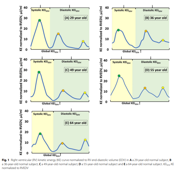HEARTinMagnet's tweet photo. Age and sex-specific REFERENCE VALUES of biventricular flow components and kinetic energy by #4DflowCMR in health.⬇️
https://t.co/9onAHsP2MQ
@canSCMR @SCMRorg @escardio @BSCMR @Cardiac_MRI @journalofCMR @CMRPapers @WHYCMR_BOT
Insightful paper in collaboration with @lzhongnhc https://t.co/EoigKqlvsF