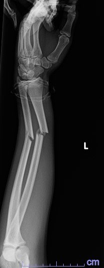 orthoEMpearls's tweet photo. An 11 year old male presents to the emergency department after falling off of the monkey bars. What is Dx and management? #emergencymedicine #FOAMed #ortho https://t.co/g7Kay3kmAs