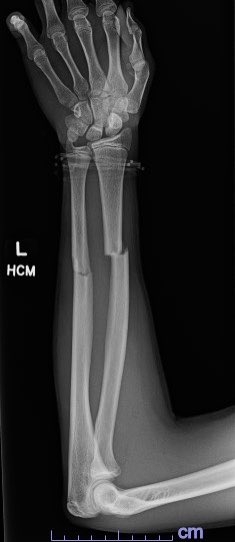 orthoEMpearls's tweet photo. An 11 year old male presents to the emergency department after falling off of the monkey bars. What is Dx and management? #emergencymedicine #FOAMed #ortho https://t.co/g7Kay3kmAs