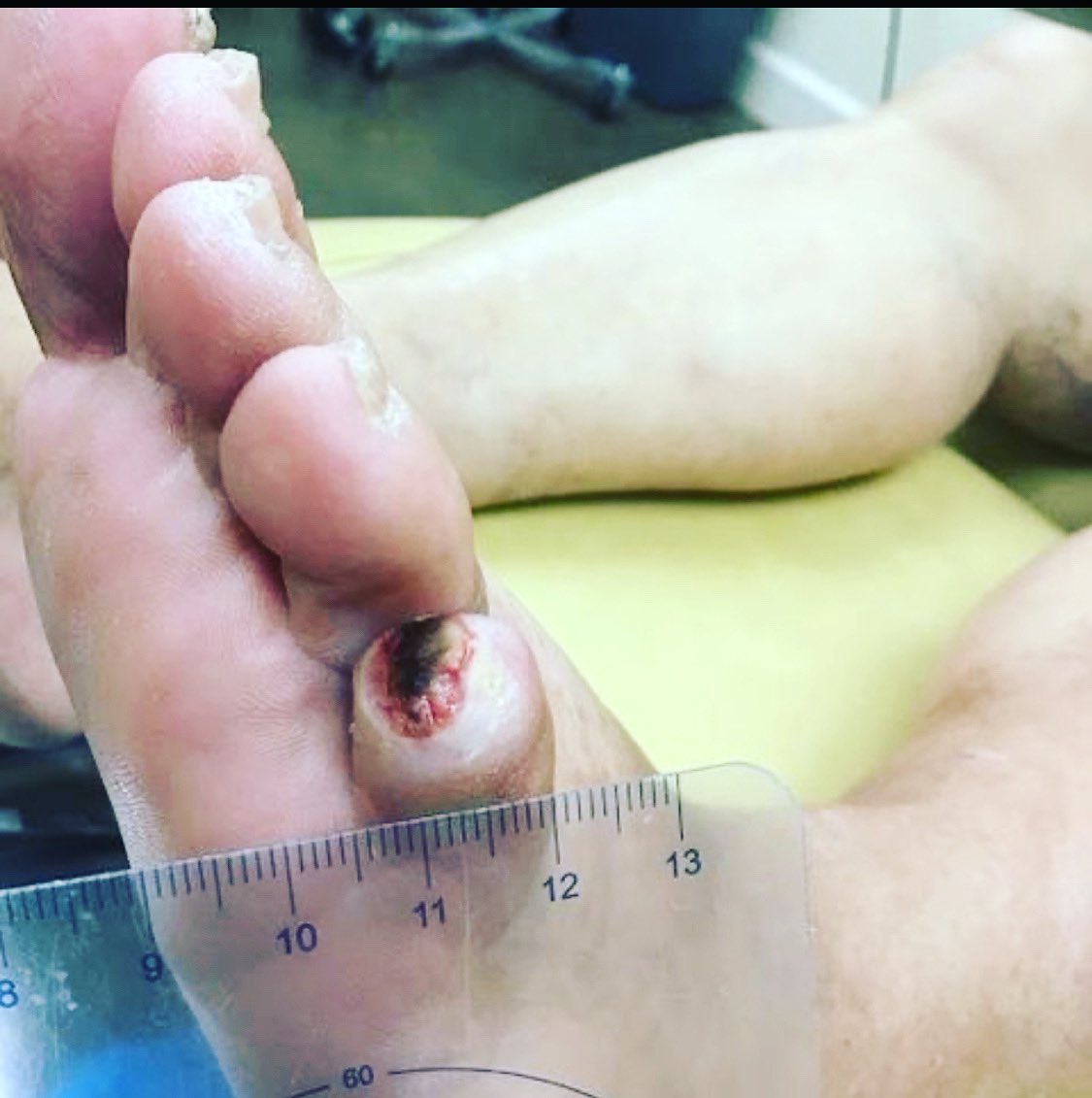 New #padawareness &amp; #showyourtoes quiz. The patient says this wound has been present for several weeks. Minimal wound pain, but has calf pain with walking. There are pedal pulses. Does this patient still need a vascular workup?

A) True
B) False

Post your response below