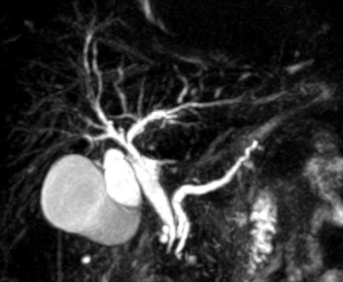 Syed A. Ahmad (@syedaahmad5) on Twitter photo “Double Duct Sign”. Dilated bile duct/ dilated pancreas duct on imaging. This is a mass in the head of pancreas until proven otherwise. <a href="/juliomayol/">Julio Mayol</a> <a href="/TomVargheseJr/">Tom Varghese Jr. MD, MS, MBA, FACS, MAMSE 🇺🇸</a> <a href="/SSATNews/">SSAT</a> <a href="/SAGES_Updates/">SAGES is in Tampa in 2026!</a> “Double Duct Sign”. Dilated bile duct/ dilated pancreas duct on imaging. This is a mass in the head of pancreas until proven otherwise. <a href="/juliomayol/">Julio Mayol</a> <a href="/TomVargheseJr/">Tom Varghese Jr. MD, MS, MBA, FACS, MAMSE 🇺🇸</a> <a href="/SSATNews/">SSAT</a> <a href="/SAGES_Updates/">SAGES is in Tampa in 2026!</a>